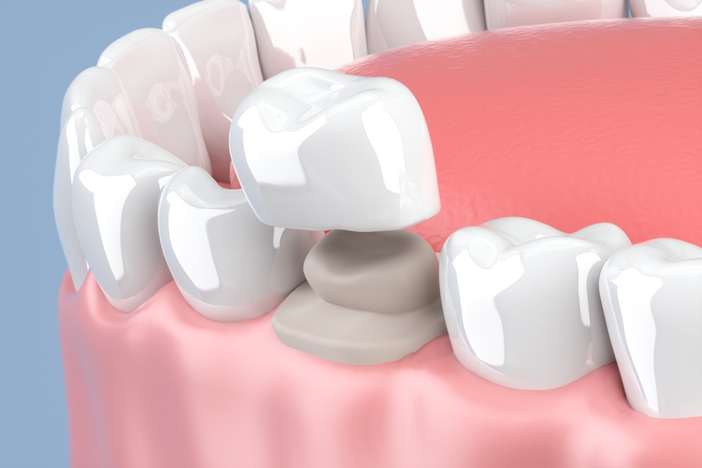 3d render of jaw with teeth and dental crown restoration. 3D illustration